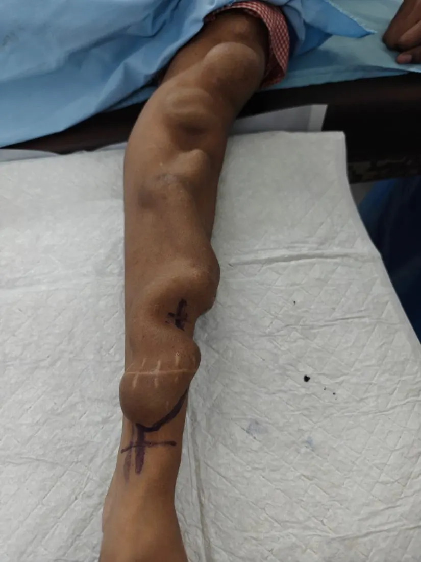 Forearm with large aneurysmal AV fistula before surgery