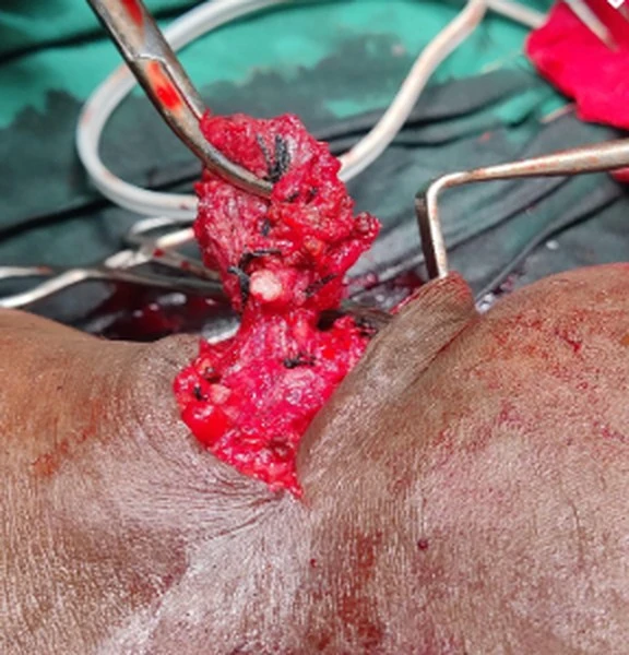 Venous malformation excision