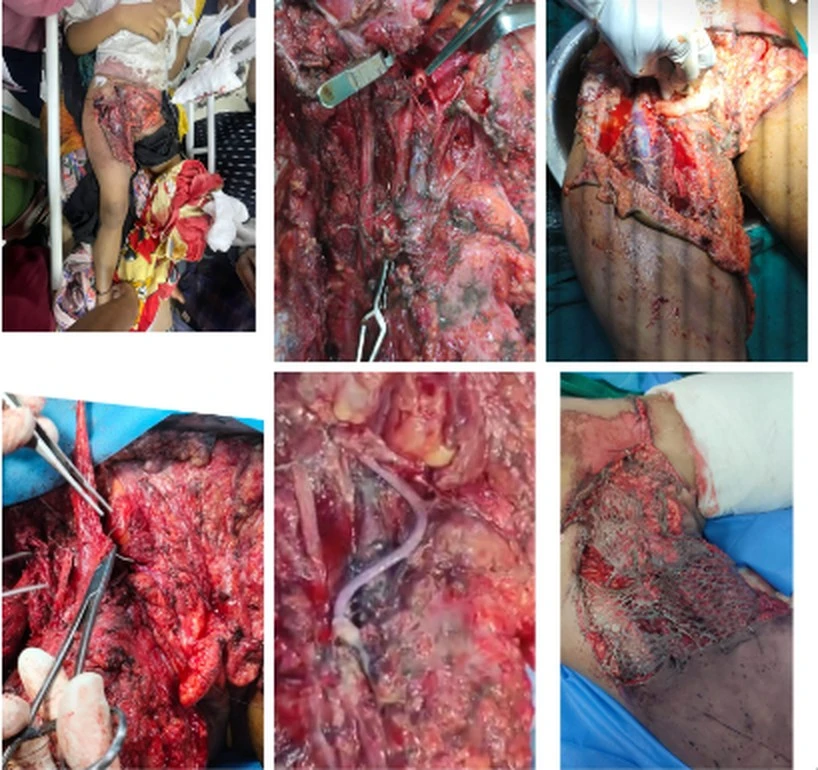 Traumatic vascular reconstruction