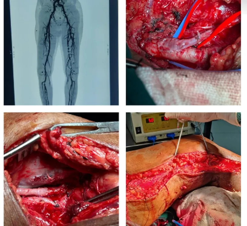 Open lower-limb bypass for chronic limb ischaemia
