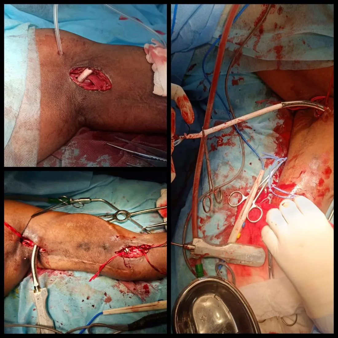 AV fistula created with a graft